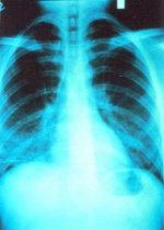 Radon i lungene